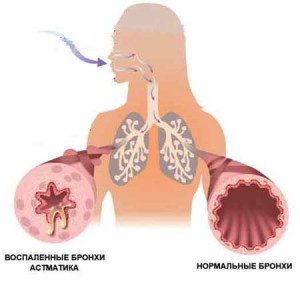 Бронхиальная астма на картинке.